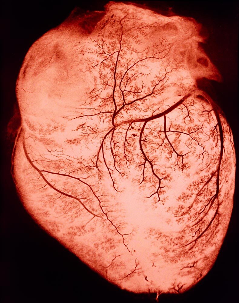 A human heart, showing the arteries and veins which supply blood to the cardiac muscles. The blood vessels, which lie immediately below the surface of the heart, have been injected with a dye, making visible even the smallest capillaries that form this exquisite arterial network.