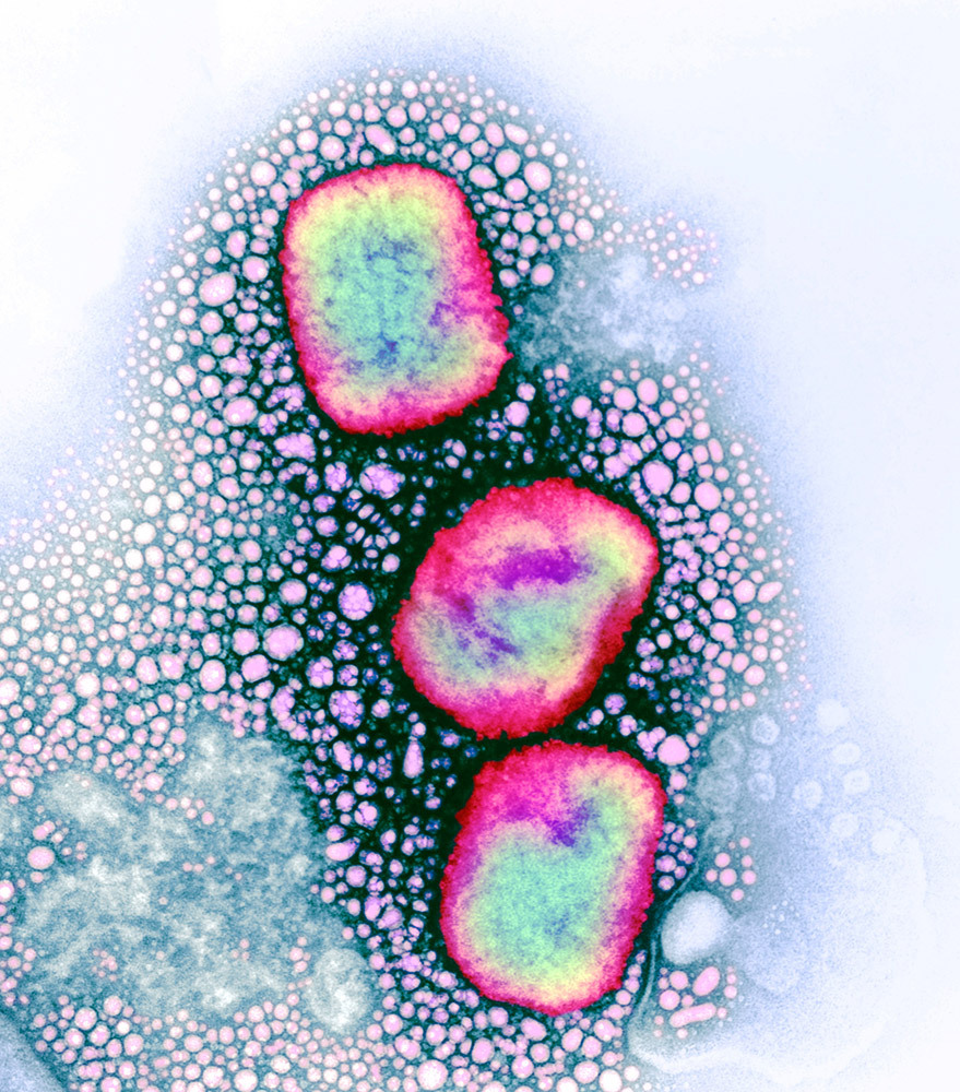 A colorized microscopic view of 3 mpox particles, highlighting the lipid envelope in pink-red and the DNA in blue-green