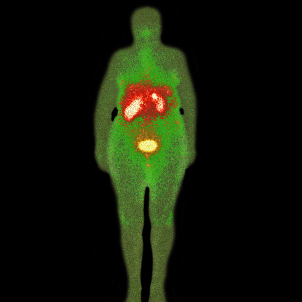 A full-body scan highlighting cancerous tissues in a patients upper and lower abdominal cavity.