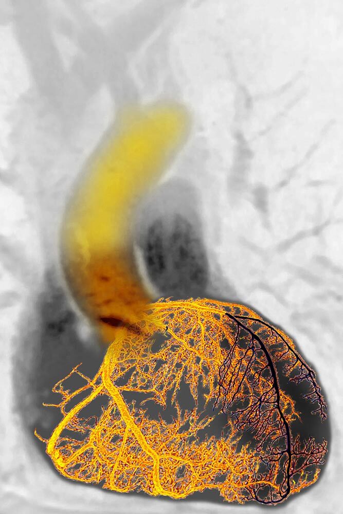 Colorized coronary angiogram showing myocardial infarction of the left anterior descending coronary artery, which is the most fatal type of heart attack