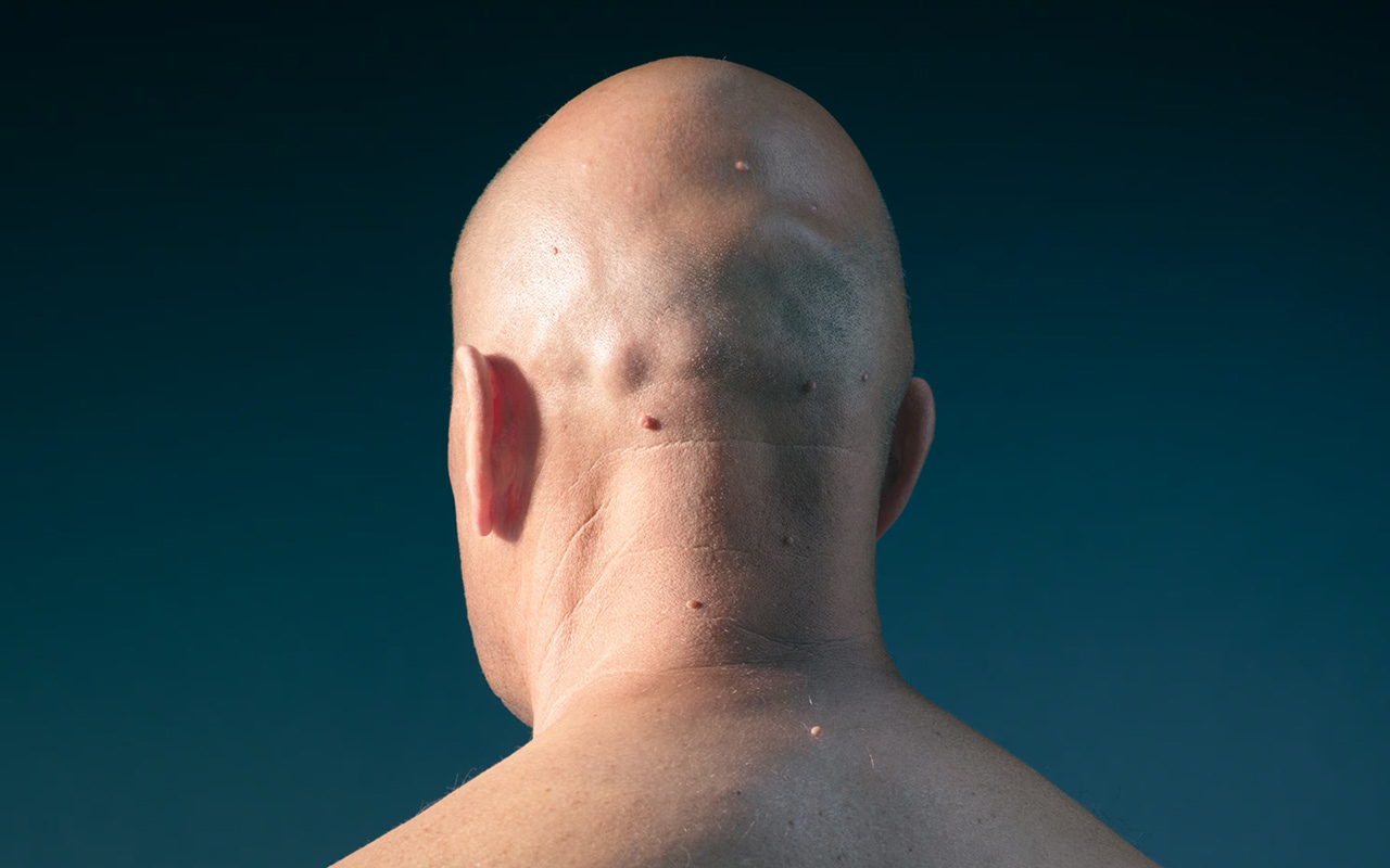 Male pattern baldness happens when hair at the top of the scalp reacts to male sex hormones. Female pattern baldness, however, is much less understood.