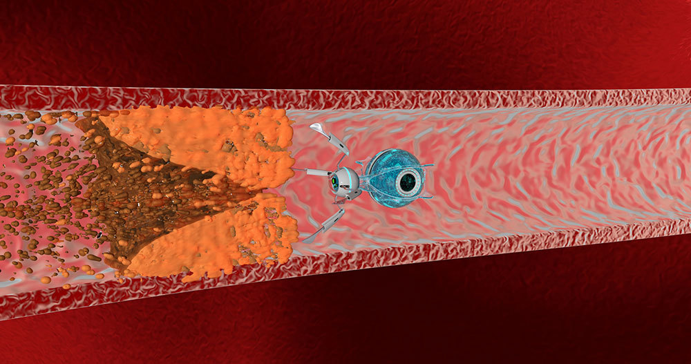 a computer-simulated nanorobot in a blood vessel finds and removes plaque