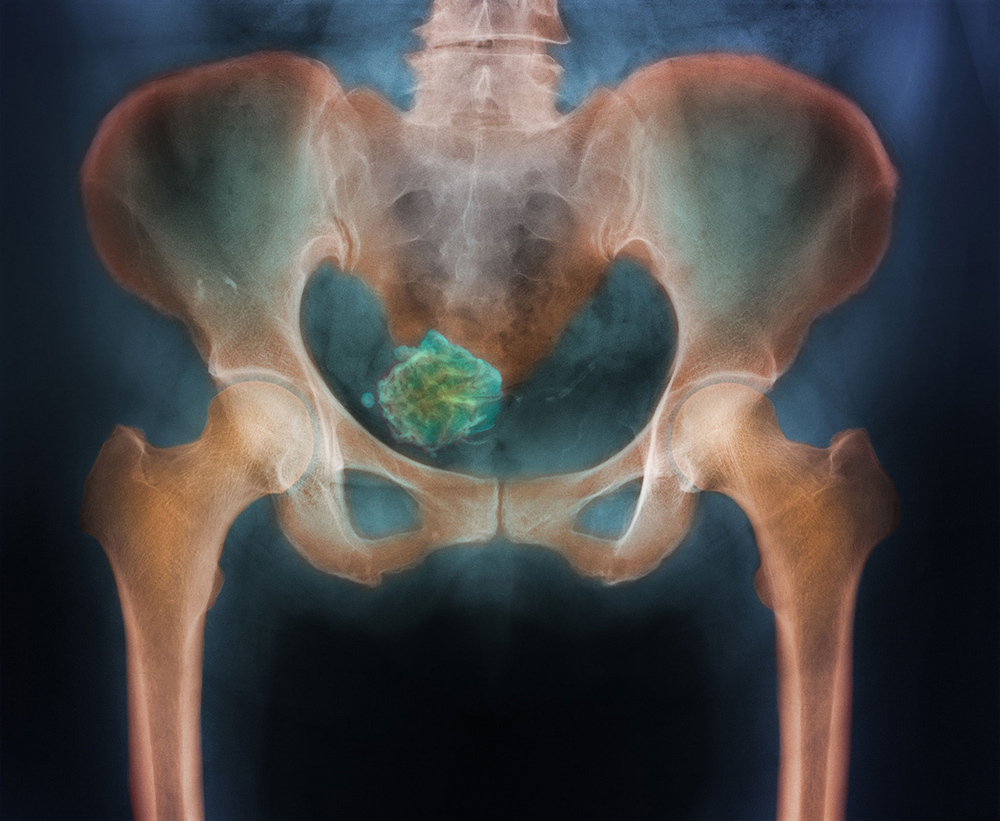 A colored pelvic X-ray of a woman's calcified uterine fibroid, blue and green in color.