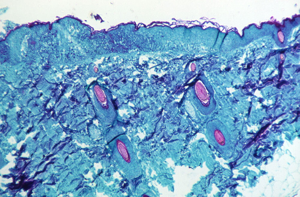 A microscopic view of a lesion