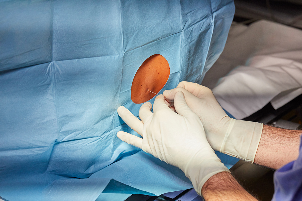 The gloved hands of a doctor carefully inserting an epidural catheter into an exposed portion of a patient’s back.