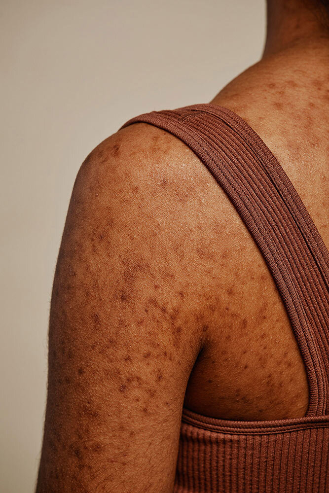 a woman with acne scars on her back and shoulders