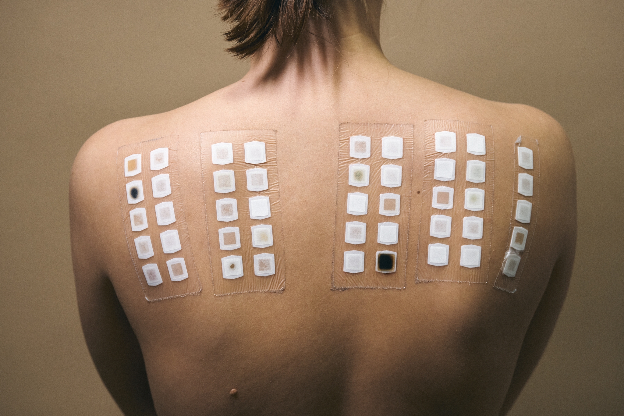 Atopy patch testing is one way to determine if a food is actually causing an allergic reaction.