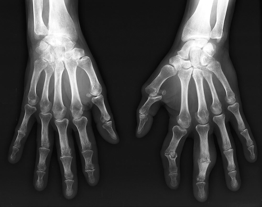 an x-ray of a person's hands