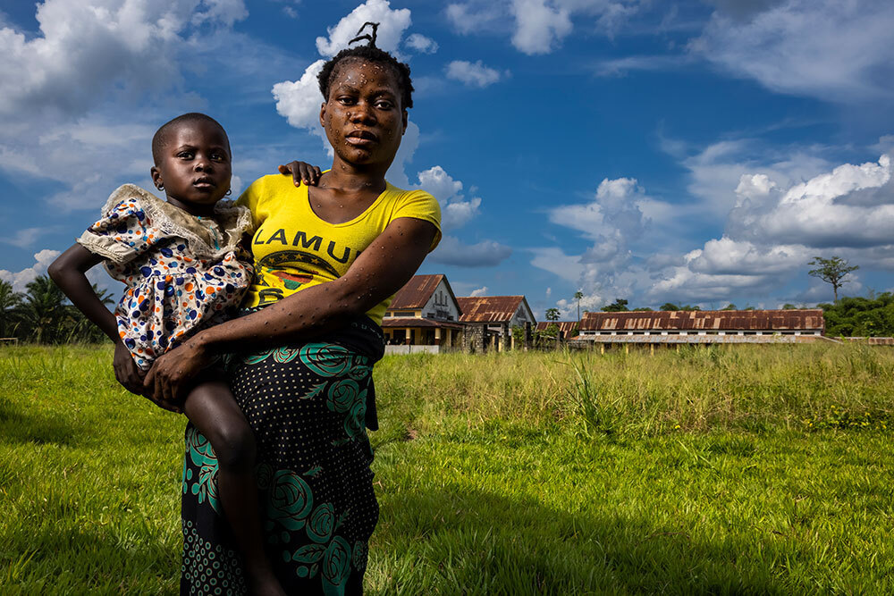 A woman with monkeypox marks on her face holds a child on her hip