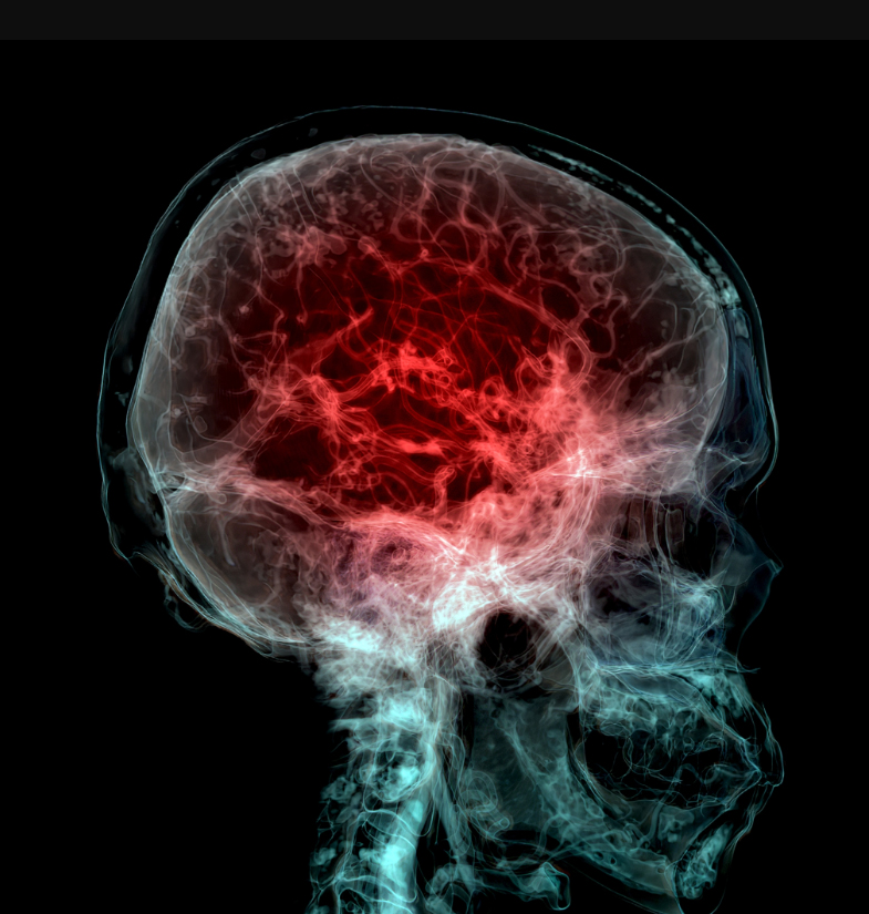 A colorized CT scan of the brain revealing blood vessels in the brain. A new study finds microplastics accumulate at higher levels in human brains than in the liver and kidneys. 