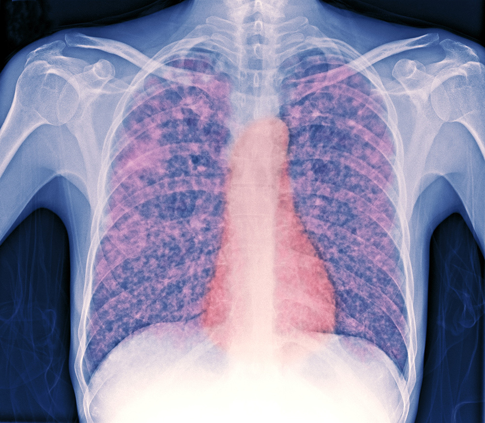 A colorized X-ray showing opacities, highlighted in pink, throughout a patient's lungs.