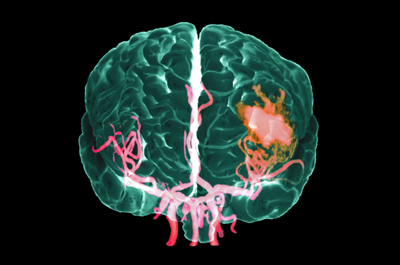 A colored three-dimensional MRA scan shows internal bleeding (red, center right) in a hemorrhagic stroke victim's brain (with arteries shown in pink).