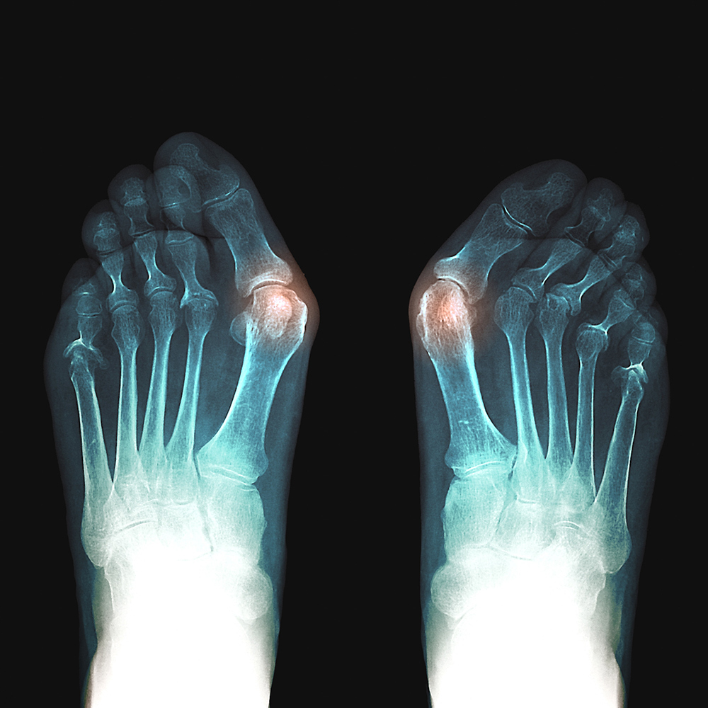 An X-ray image of the feet of a 54-year old patient with bunions, bony growths of the big toes that are highlighted in orange .