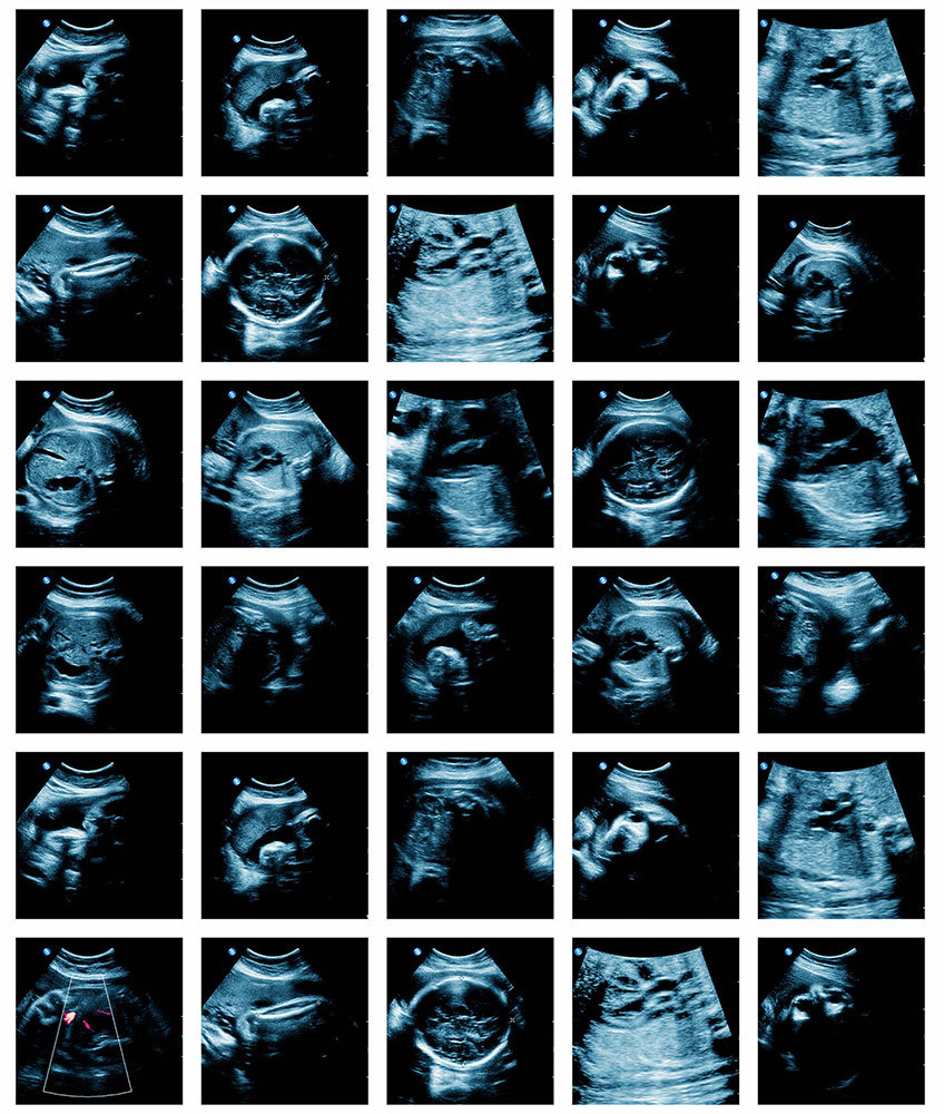 A picture of ultrasounds of a fetus