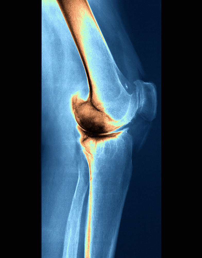 This x-ray image shows the left knee of a 54-year-old woman with rheumatoid arthritis.