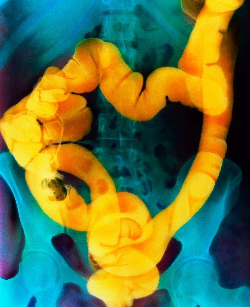 This colorized abdominal X-ray shows cancer of the ascending colon; the tumor appears as the oval shadow over the right pelvic bone (left on image). ​