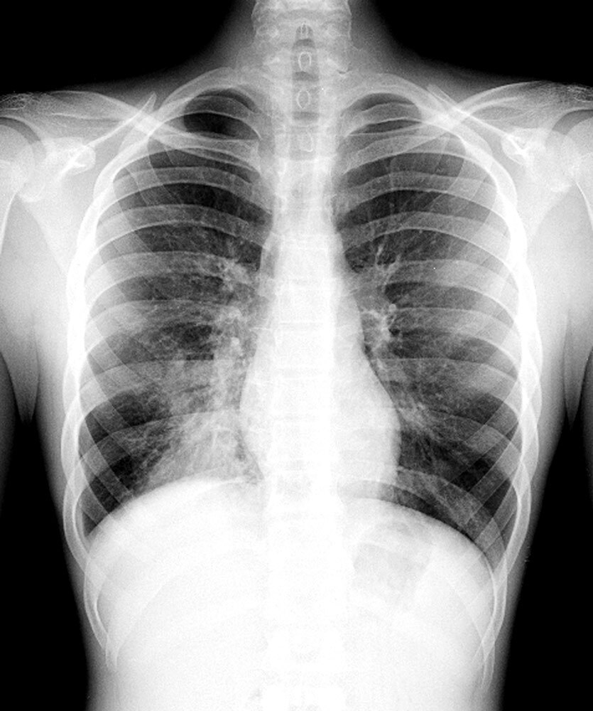 This chest x-ray shows more opacity next to the lower right border of the heart—a sign that the lower lobe of the right lung is consumed with pneumonia (left side of the frame).