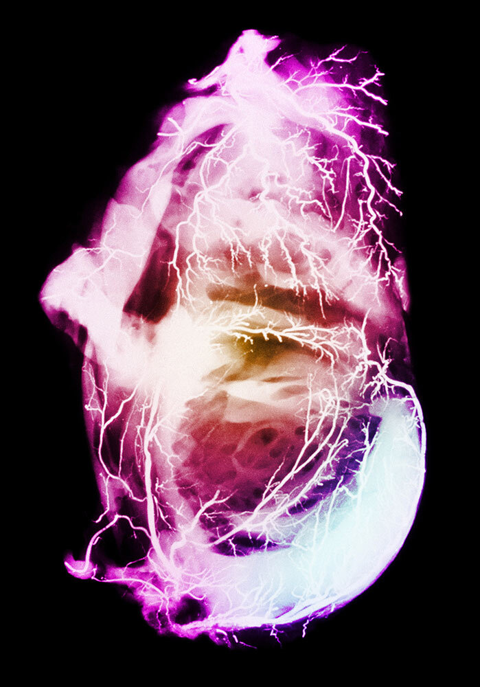 Heart attacks, or myocardial infarctions, occur when the blood supply to the heart is partially or completely blocked. This angiogram shows the death of part of the heart muscle after a heart attack. Young adults are increasingly at risk for heart disease—but it's not always taken seriously.