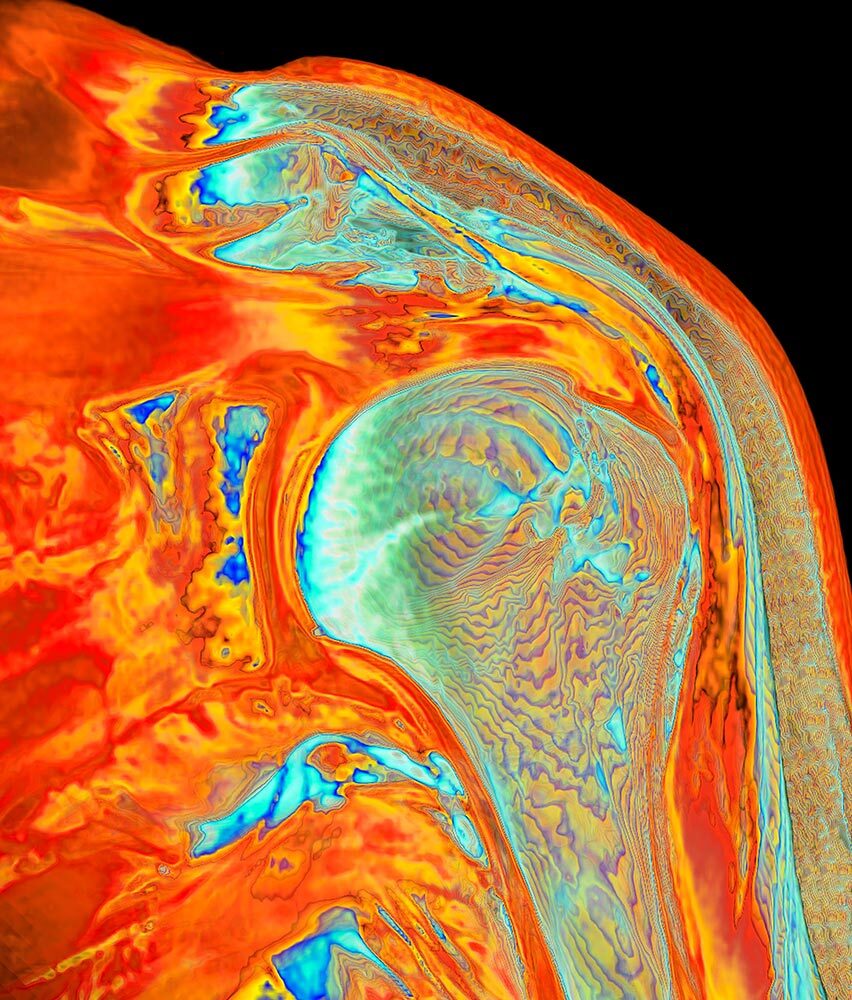 An MRI scan showing partial tears in a shoulder tendon