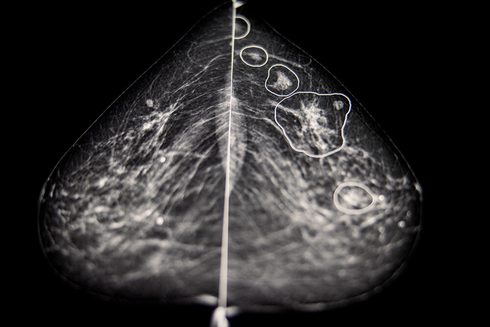 an x-ray showing breasts with potential anomalies