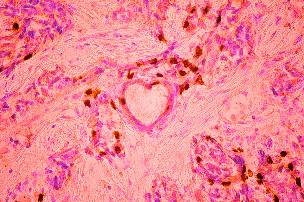 This microscopic view of breast cancer cells, which won third place, formed the shape of a heart.