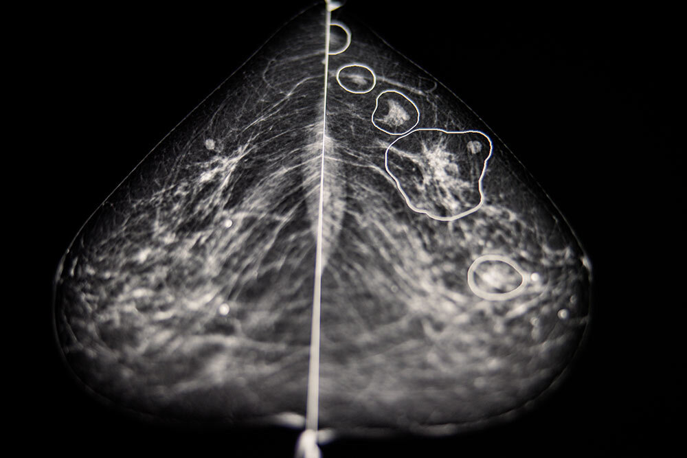 a mammogram scan