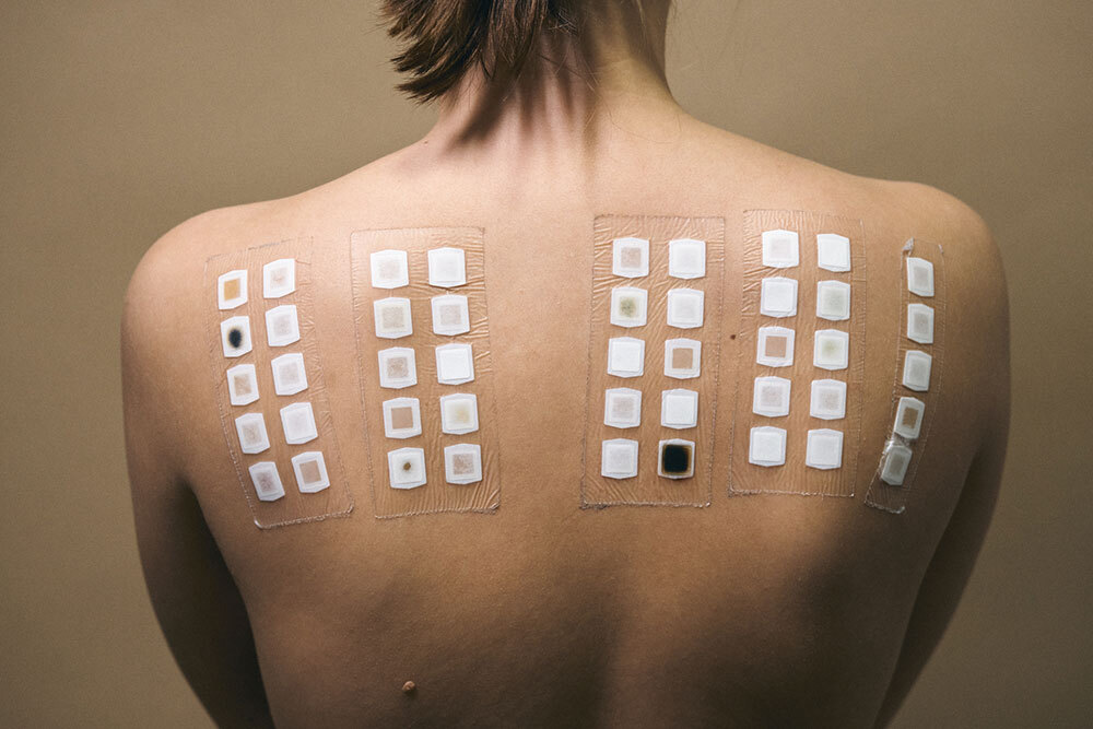 A picture of someone receiving a food allergy test on their back