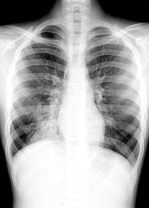 This chest x-ray shows more opacity next to the lower right border of the heart—a sign that the lower lobe of the right lung is consumed with pneumonia (left side of the frame).