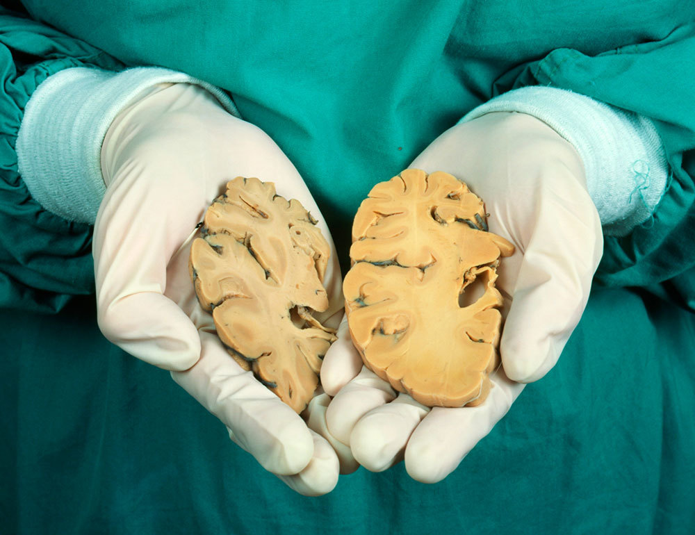 A picture of gloved hands holding two slices of brains