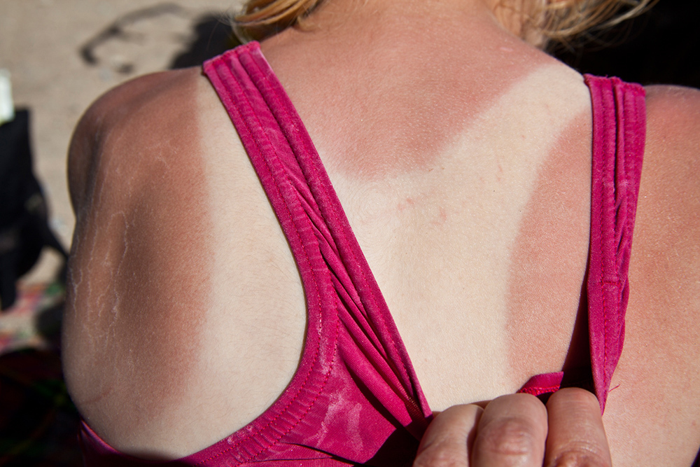 A woman’s back with stark tan lines left by swimming costume.