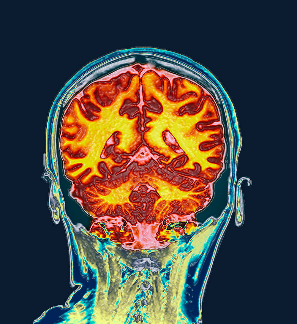 Colored coronal magnetic resonance imaging (MRI) scan of the brain of a healthy, premenopausal 32-year-old woman.