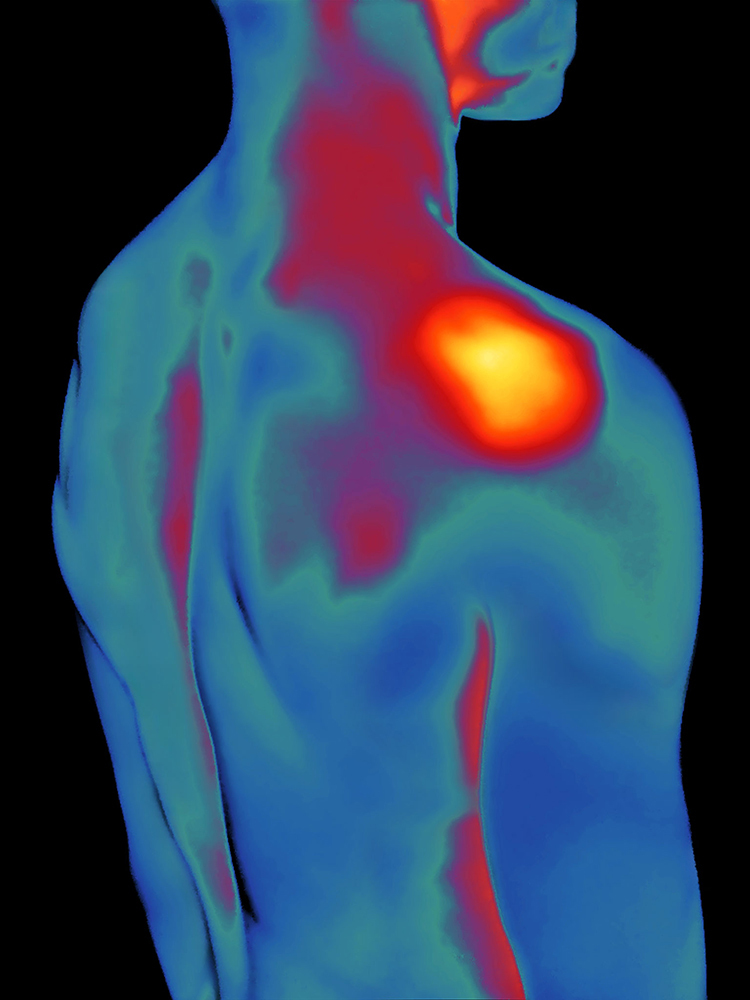 A thermal image of the body from the neck to the waist the area around the shoulder joint is red and orange, while the other parts of the body are blue