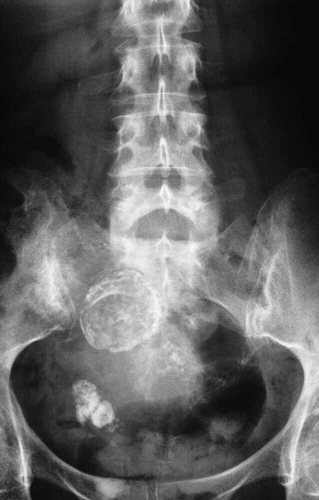 an x-ray of a front-fact pelvic