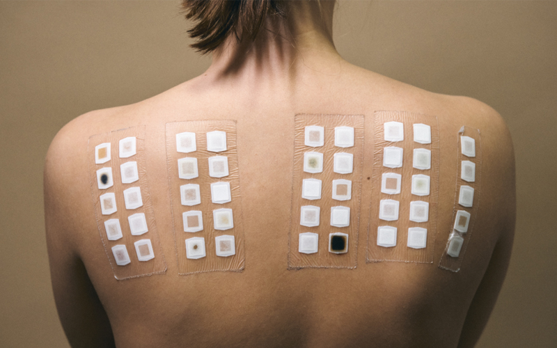A woman’s back is covered in allergen patches for atopy patch testing (APT), which is one way to determine if a food is actually causing an allergic reaction.