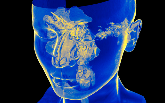A blue and yellow colored 3D computed tomography (CT) scan of the spaces within the facial bones surrounding the nasal cavity.
