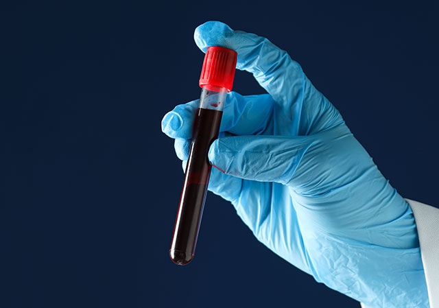 A hand in a blue surgical glove holds a vial of blood. 