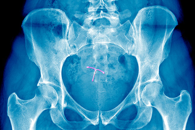 An image of an IUD in an X-Ray of the cervix. 