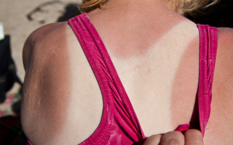Bathing suit straps are pulled away on the upper back to reveal a tan line.