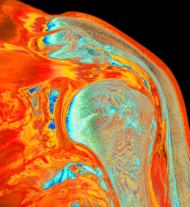 An MRI scan showing partial tears in the shoulder tendon. 