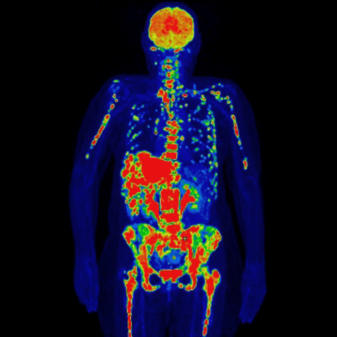 A PET scan of a female patient with breast cancer, which has spread to the lymph nodes, bones and liver.