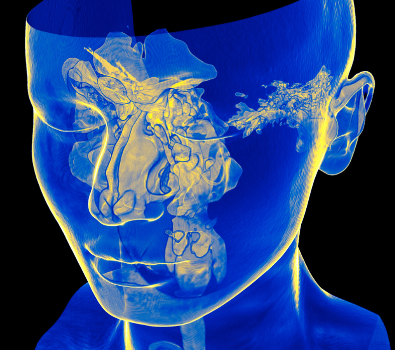 Blue and yellow colored 3D computed tomography (CT) scan of the spaces within the facial bones surrounding the nasal cavity.